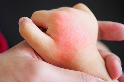 How To Treat Mosquito Bites On Babies